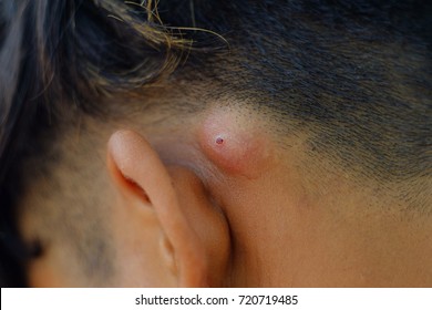 Folliculitis .Skin Inflammation .