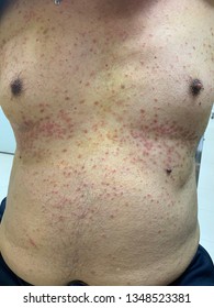 Folliculitis At Trunk