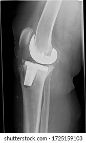 Follow up lateral view x-ray showing severe loosening of tibial component of total knee prosthesis