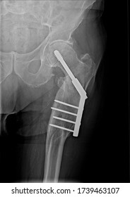Follow up posterior anterior femur x-ray showing healed per-/sub - trochanteric fracture after stabilization with dynamic hip screw with long plate
