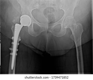 Follow Posterior Anterior View Hip Xray Stock Photo 1739471852 ...