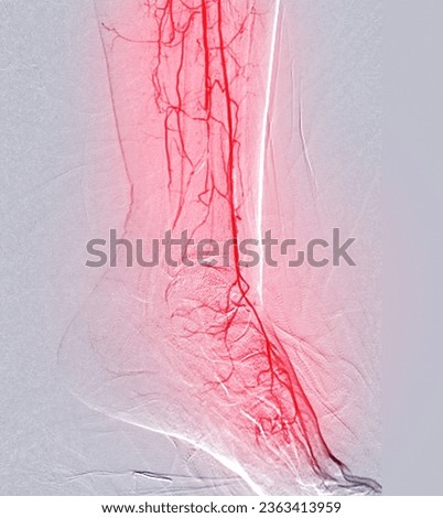 Foot angiorgam or Plantar angiogram angiogram showing  Plantar and Tarsal  Artery at foot area.