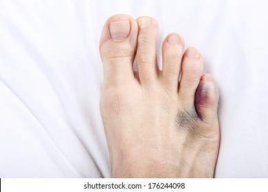 Bruised Toe High Res Stock Images Shutterstock