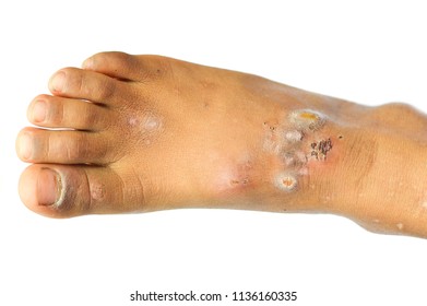 Scabies Images, Stock Photos & Vectors | Shutterstock