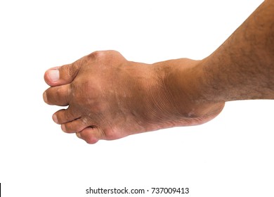 Foot disease or gout isolated or white background.