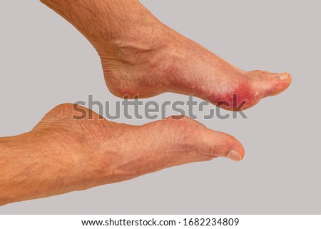 Foot disease Rheumatism and gout. Red leg swelling. Pain in the foot