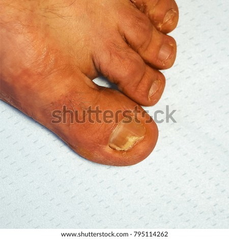 Foot foot. Disease of the skin. Fungal infection.