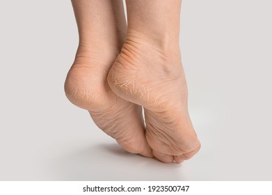 foot with dry skin on heel and sole. women female feet with rough cracked skin. Cracked heel on woman's foot. Dry heels and soles woman on white background closeup