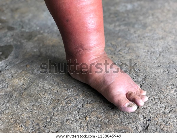 Foot Elderly Has Swollen Foot Ankle Stock Photo Edit Now 1158045949