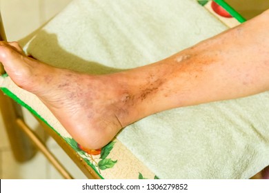 Foot of elderly woman with phlebitis, edema and infection on chair