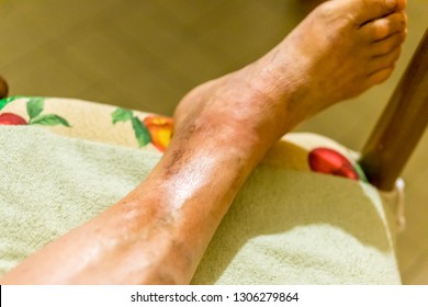 Foot of elderly woman with phlebitis, edema and infection on chair