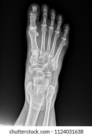 Foot Front View X Ray