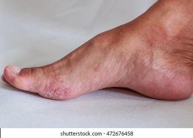 Foot Is A Fungal Infection