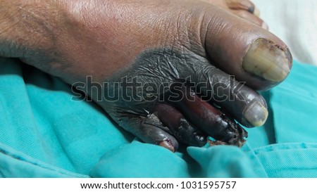 Foot Gangrene due to Acute Limb Ischaemia