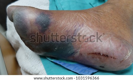 Foot Gangrene due to Acute Limb Ischaemia