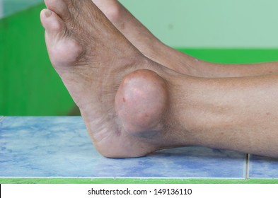 Foot Of Gout Patient