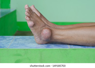 Foot Of Gout Patient