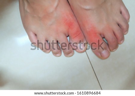 Foot of gout patient.Close up Painful and inflamed gout.