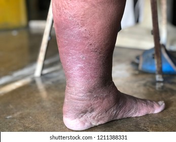 Foot Leg Elderly Has Swollen Foot Stock Photo Edit Now 1211388331