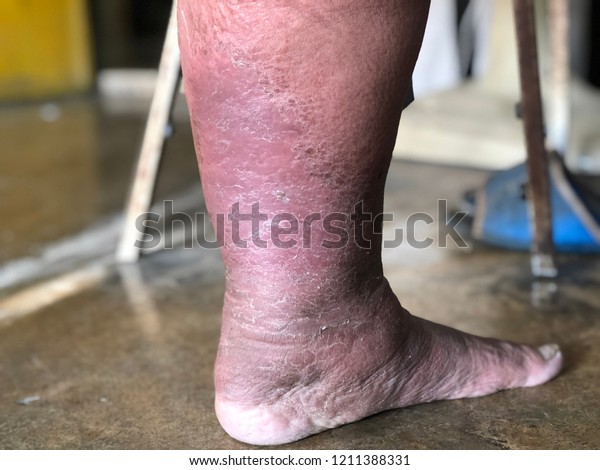 Foot Leg Elderly Has Swollen Foot Stock Photo Edit Now 1211388331