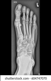 Foot Medical Xray, Lower Limb Bones