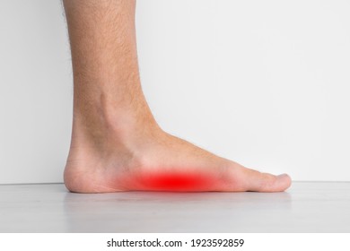 Foot pain because of strong flat feet also called pes planus or fallen arches. The arches on the inside of feet are flattened - Shutterstock ID 1923592859