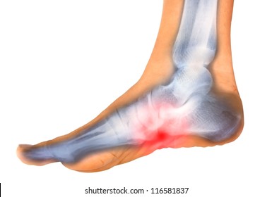 foot pain on x-ray