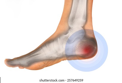 foot pain on x-ray 