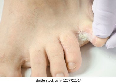 Fungus Between Toes Images, Stock Photos & Vectors | Shutterstock