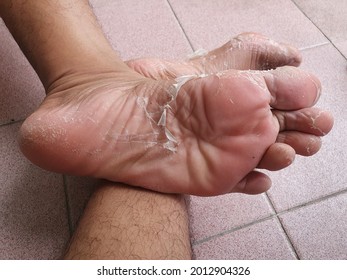 A Foot Skin Peel Off. Closed Up Cracked Skin And Peeling Foot Due To Fungal Infection, Sun Burn, Dry Skin Or Dehydration Or Sweaty