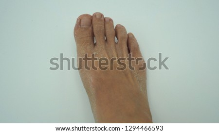  Foot skin is peeling with white background.