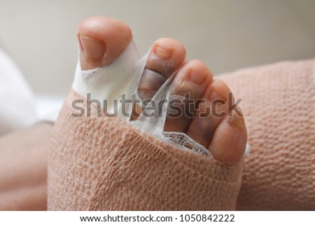 Foot surgery - bandage
