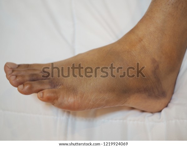 Foot Swelling Bruise Broken Foot Close Stock Photo (Edit Now) 1219924069