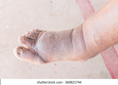 Foot swelling on diabetic Nephropathy