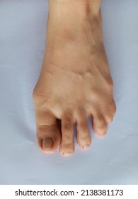 Foot With Syndactyly Syndrome Or Webbed Toes.