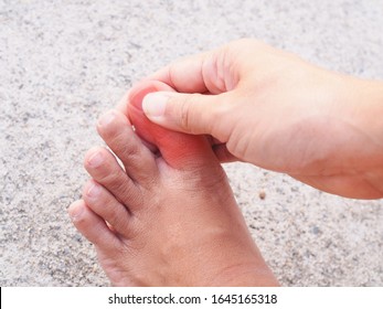 Foot And Toe Pain Or Numbness In Feet, Injury With Inflamed Nails, Hong Kong Foot Disease.