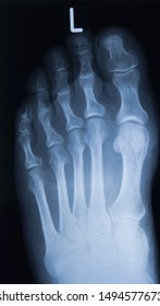 Foot and toes injury xray scan 