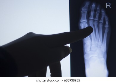 Foot Toes Joint Xray Test Scan Stock Photo 688938955 | Shutterstock