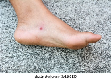 Diabetic Sores On Feet Images - DiabetesWalls