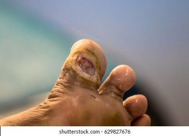 Foot Ulcer, Gangrene At Big Toe.