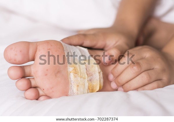 Foot Ulcer Wounds Broken Glass Stock Photo (Edit Now) 702287374