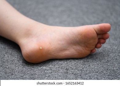 Foot wart, verrucas plantar on the foot of a child from Sweden. A  decease caused by the Human papillomavirus and often spread at communal showers or by sharing socks with others.