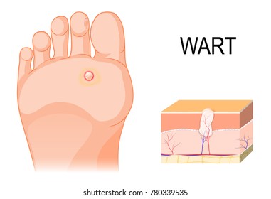Foot warts on the bottom of soles and toes. Cross section of a common wart. Illustration showing the characteristic features (hyperkeratosis, acanthosis, hypergranulosis and large blood vessels).