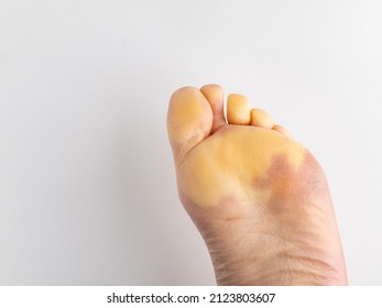 Foot Of White Woman Suffering From Rheumatological Autoimmune Disease. Reynaud's Phenomenon. Red And White Skin, Cold Allergy, Poor Blood Circulation. White Background. Copy Space. Health Care Concept