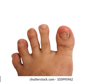 Foot Without Toe Nail And Bruise On Nails