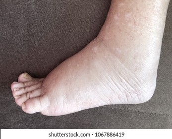 Foot Of A Woman Has Edema Illness