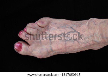 Foot at woman who had arthritis in many years (Reumatoid artrit (RA).