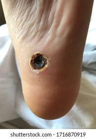 Foot Wound And Problem Skin/Ulcer