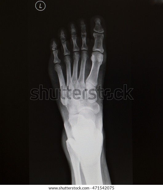 Foot Xray Anterior Posterior View Stock Photo 471542075 | Shutterstock
