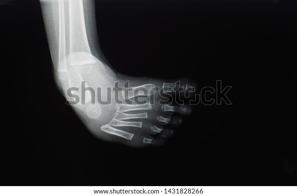 Foot\
x-ray of a child with birth defect and deformity. Clubfoot or\
talipes equinovarus present with cavus foot, varus foot, metatarsus\
adductus and equinovarus. Ponseti casting is\
needed.